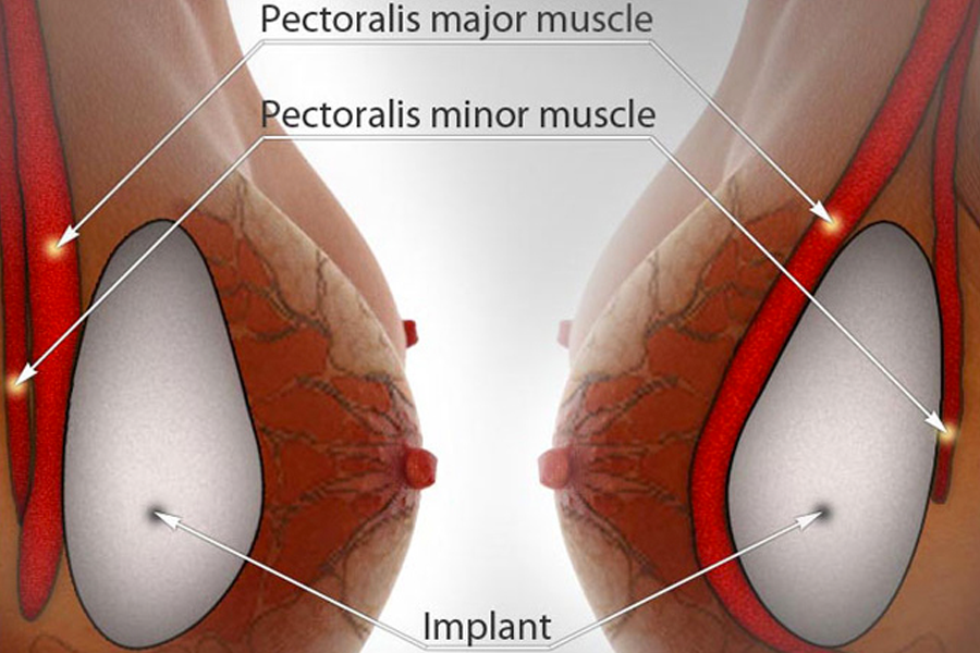 Фитнес тренировки след мастектомия и поставяне на гръдни импланти подмускулно | Жени